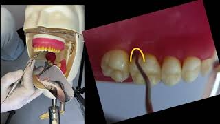 Raspagem periodontal supragengival  Primeiro sextante [upl. by Hillhouse]