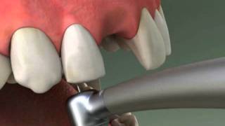 Dentist  Maryland Bridge Procedure [upl. by Neelhsa]