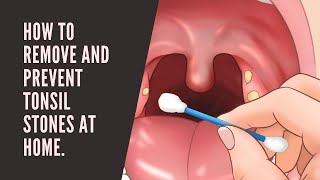 How to remove and prevent tonsil stones at home [upl. by Fawne345]