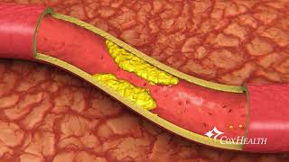 Heart Stents [upl. by Heyman21]