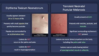 Erythema Toxicum Neonatorum vs Transient Neonatal Pustular Melanosis [upl. by Alin]