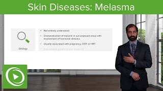 Skin Diseases Melasma Chloasma – Pathology  Lecturio [upl. by Daphene890]