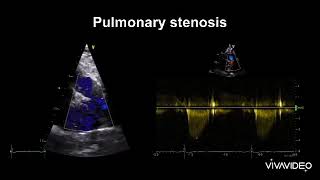 Pulmonary Stenosis Echo [upl. by Amathiste]