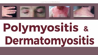 A Simplified Overview of Polymyositis amp Dermatomyositis  Clinical Features Diagnosis amp Treatment [upl. by Ajssatan]