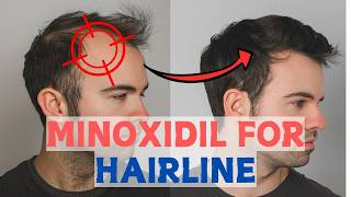 Minoxidil for Frontal Baldness  Restore Your Hairline [upl. by Imray343]