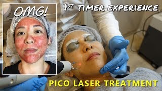 PICO Laser Treatment  1st Timers Experience  Kat L [upl. by Rebecka]