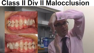 Why Class II Division II Malocclusion Inclined Teeth is Less Common in People by Dr Mike Mew [upl. by Vigen]