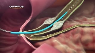 QuickPlaceV Biliary Stent [upl. by Gatias588]