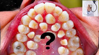 MORE THAN 500 TEETH I Hyperdontia I Gardner syndrome supernumerary teeth ISabaceous Cysts [upl. by Linn156]