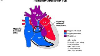 Pulmonary Atresia [upl. by Oznole772]