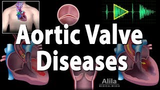 Aortic Valve Disease Animation [upl. by Liartnod]