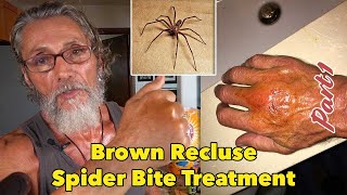 Brown Recluse Spider Bite Treatment Part 1  Dr Robert Cassar [upl. by Irrac]