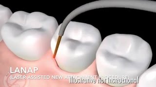 How Does Laser Surgery Work Treat Gum Disease  LANAP [upl. by Castillo]