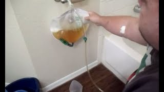 Kidney Failure After 20 Day Water Fast My Story [upl. by Neeka]