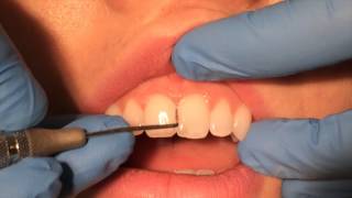 Periodontal Probing [upl. by Assiled]