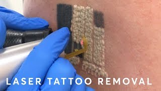 Laser Tattoo Removal PAIN RESULTS amp PROCEDURE [upl. by Anialram]