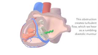 Mitral Stenosis  sound amp animation [upl. by Krause]