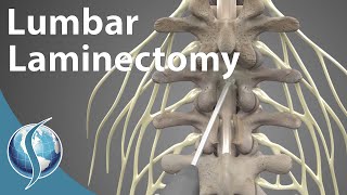 Lumbar Laminectomy [upl. by Bedwell849]