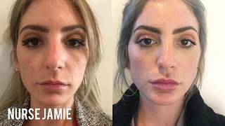 Before and After Micro Needling  Nurse Jamie [upl. by Cati642]