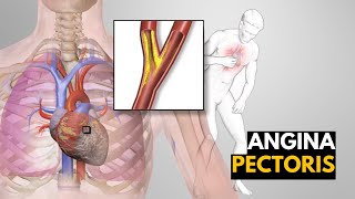 What is Angina Pectoris Causes signs and symptoms Diagnosis and treatment [upl. by Altaf]