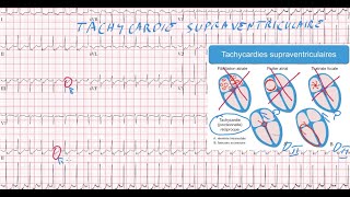 20 ECG  Quiz  Dr Synapse [upl. by Vashtia539]