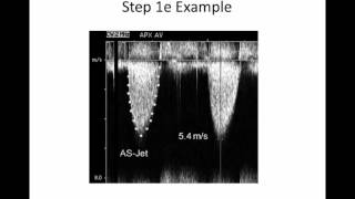 Intro to Aortic Stenosis [upl. by Ailb]