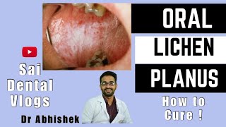 ORAL LICHEN PLANUS  HOW TO CURE [upl. by Kelwin]