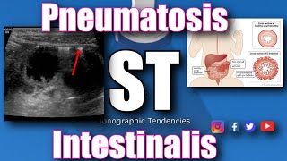 Pneumatosis Intestinalis [upl. by Neivad]