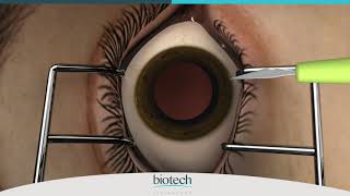 Eyecryl PHAKIC IOL Range Loading amp Implantation [upl. by Nabla404]