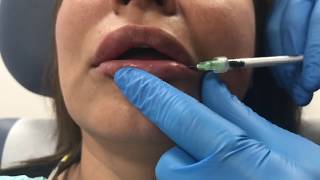 Reversing poorly placed lip filler using Hylenex hyaluronidase [upl. by Eniawed490]