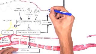 Burns  Pathophysiology [upl. by Yenobe]