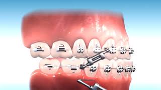 How to correct Class III Malocclusion [upl. by Glynis]