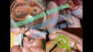 Trichomoniasis symptomsTreatment and Prevention [upl. by Airotciv316]