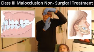 Correcting Class III Malocclusion without Tooth Extraction or Oral Surgery by Prof John Mew [upl. by Onabru]