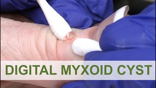 Radicular cyst  Periapical Cyst  Pathogenesis Clinical RF HF amp Treatment [upl. by Ernaldus]