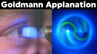 Goldmann Applanation Tonometry Procedure Technique Tutorial [upl. by Nitza]