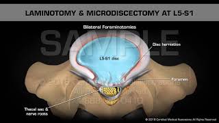 Laminotomy amp Microdiscectomy at L5S1 [upl. by Nytsyrk]