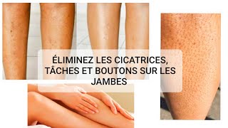 COMMENT ÉLIMINER LES CICATRICES ET BOUTONS SUR LES JAMBES [upl. by Ettenal454]