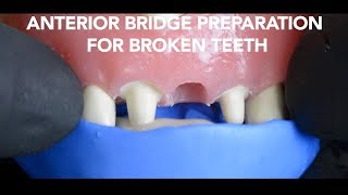 Dental Bridge Preparation after Tooth Extraction [upl. by Nomal654]