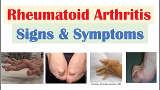 Rheumatoid Arthritis RA Signs amp Symptoms amp Associated Complications [upl. by Annert]