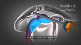 Acromioclavicular Separation Surgery [upl. by Dorelle]