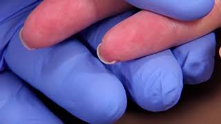 Perform a Capillary Puncture Obtain a Blood Sample by Capillary Puncture [upl. by Eenel]