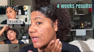 The Ordinary Peeling Solution Before amp After  4 weeks [upl. by Hinckley]