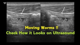 Intestinal Helminthiasis Ascariasis  Ultrasound  Case 04 [upl. by Aleacem401]