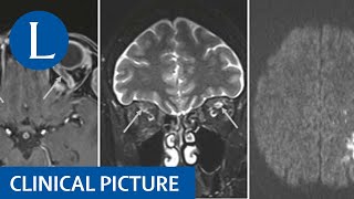 Neurological problems post vaccine against SARSCoV2 [upl. by Simmonds669]