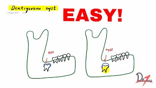 Dentigerous cyst made easy [upl. by Zetra]