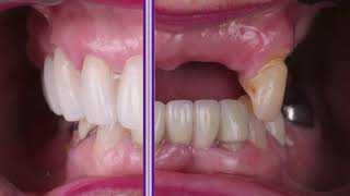 HOW BRACES WORK timelapse of HUGE maxillary Incisor [upl. by Susanne791]