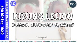 Median rhomboid glossitis  Kissing lesion  Central papillary atrophy  Dr Paridhi Agrawal [upl. by Hahnert]