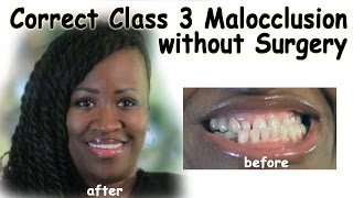 Correct Class 3 Malocclusion without Surgery  Bergen County NJ Dentist [upl. by Daj]