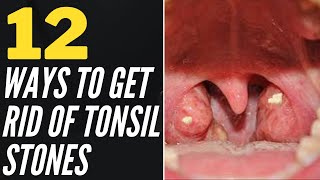 12 Ways To Get Rid Of Tonsil Stones At Home [upl. by Alodi229]